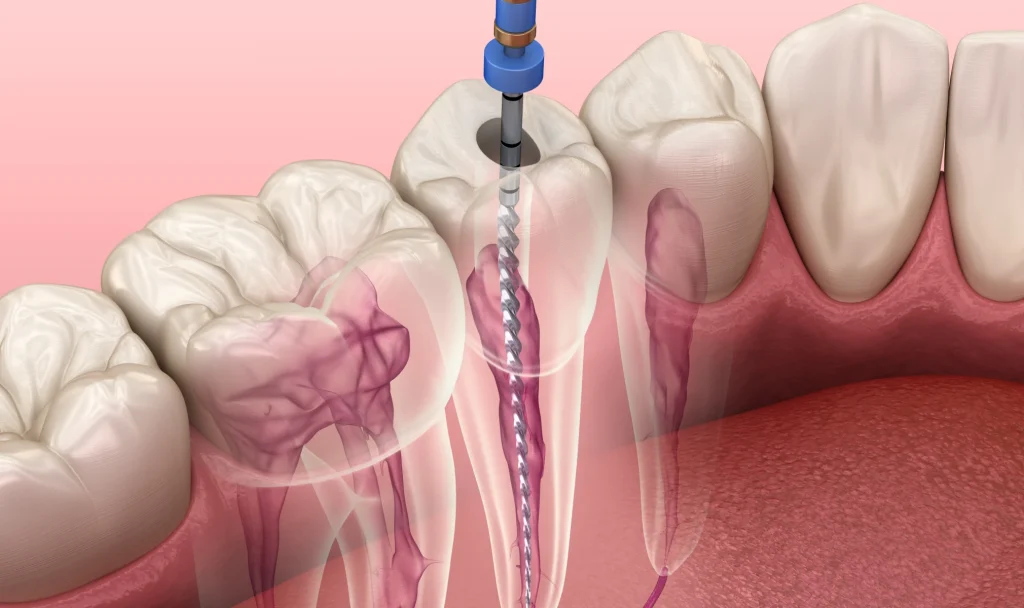 Chirurgie endodontique