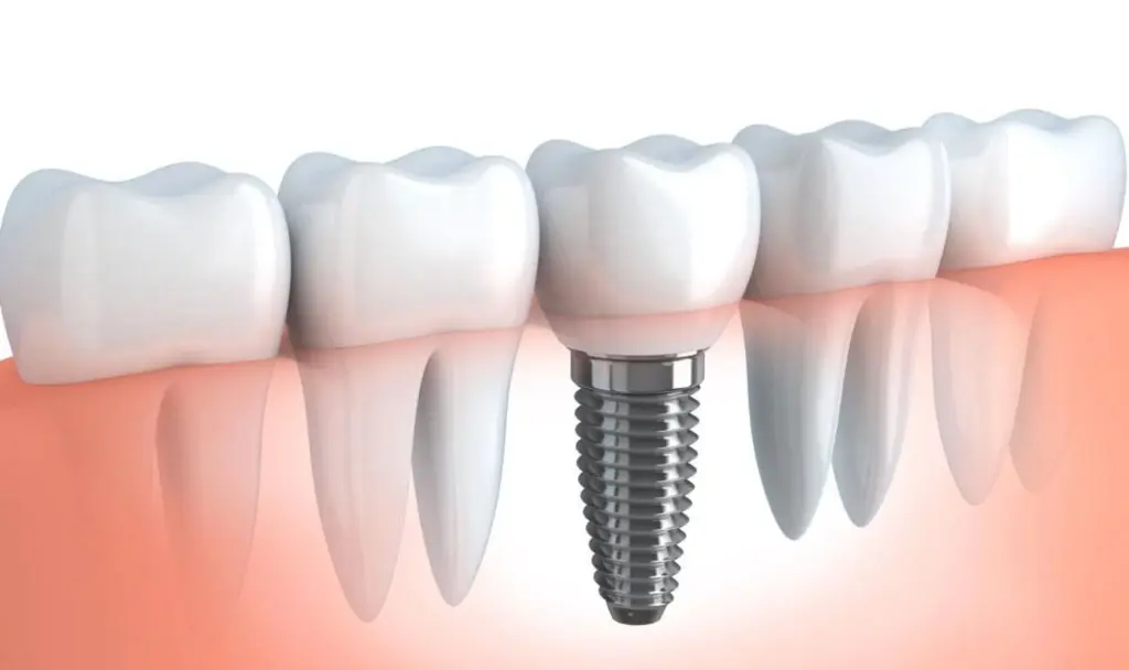 implant unitaire au Cabinet Dentaire des docteurs Yoh et Matton à Biarritz