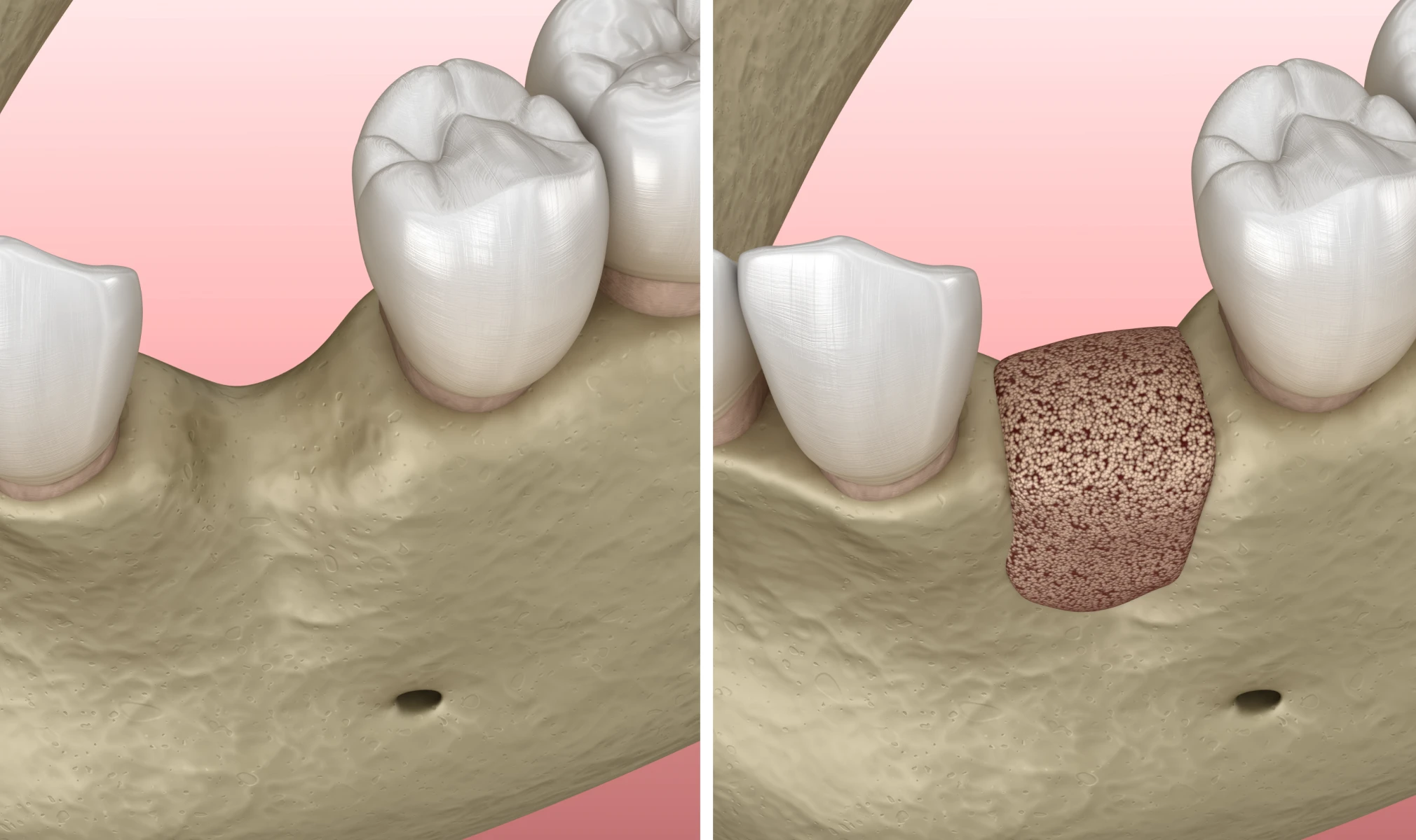 regeneration osseuse guidee au Cabinet Dentaire des docteurs Yoh et Matton à Biarritz