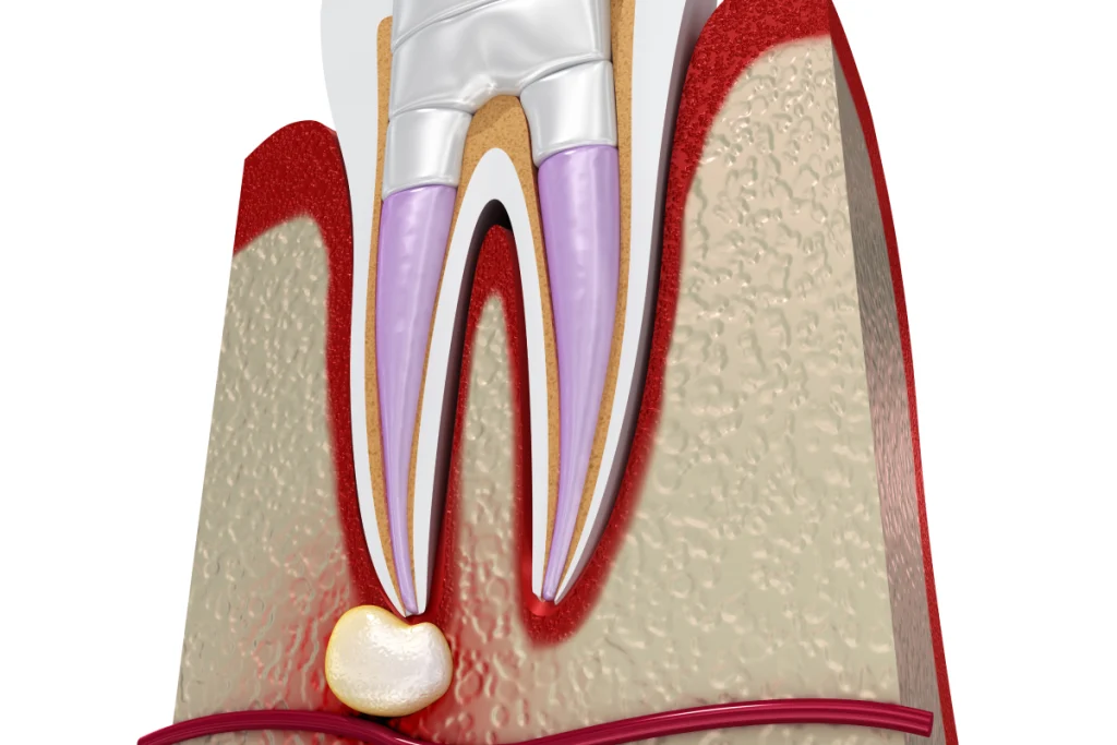 Retraitement endodontique
