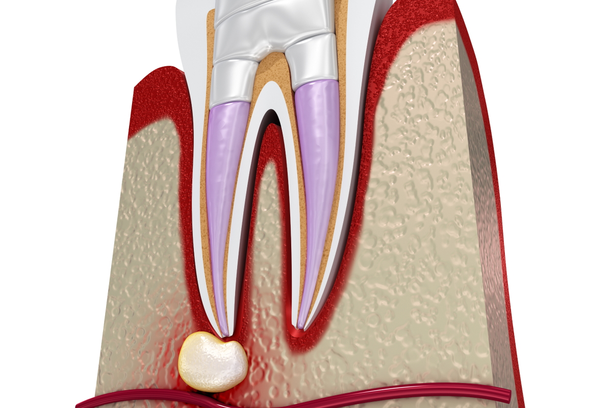 Retraitement endodontique