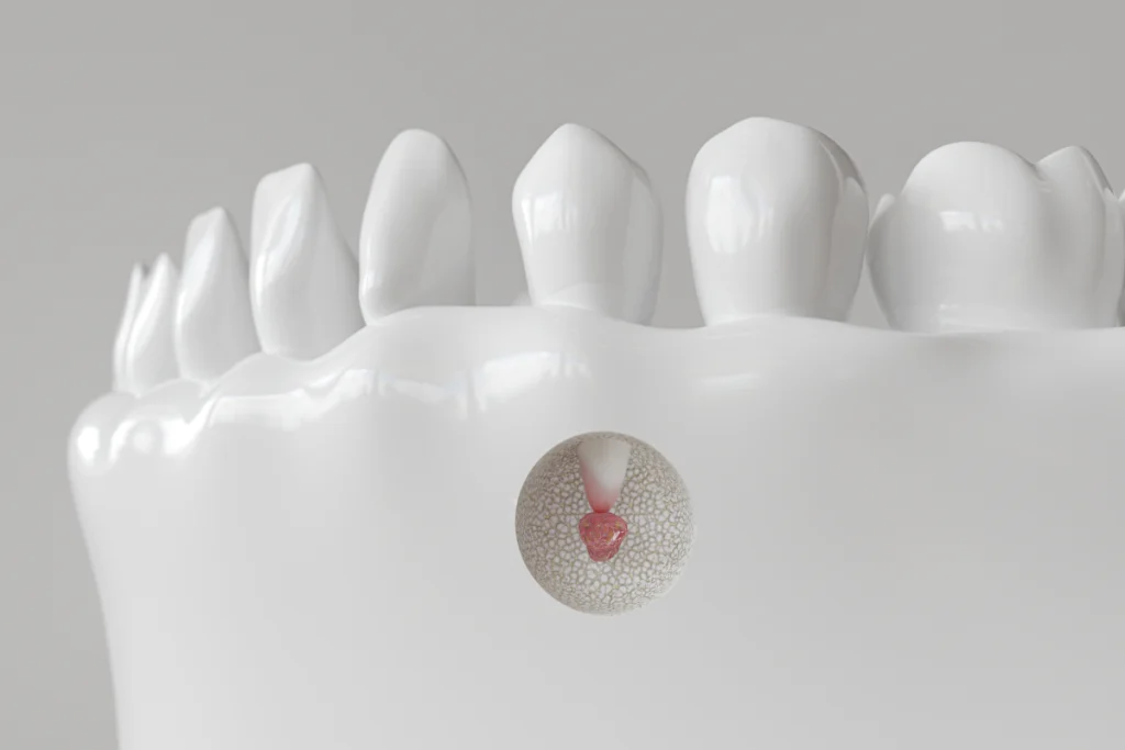 Chirurgie endodontique