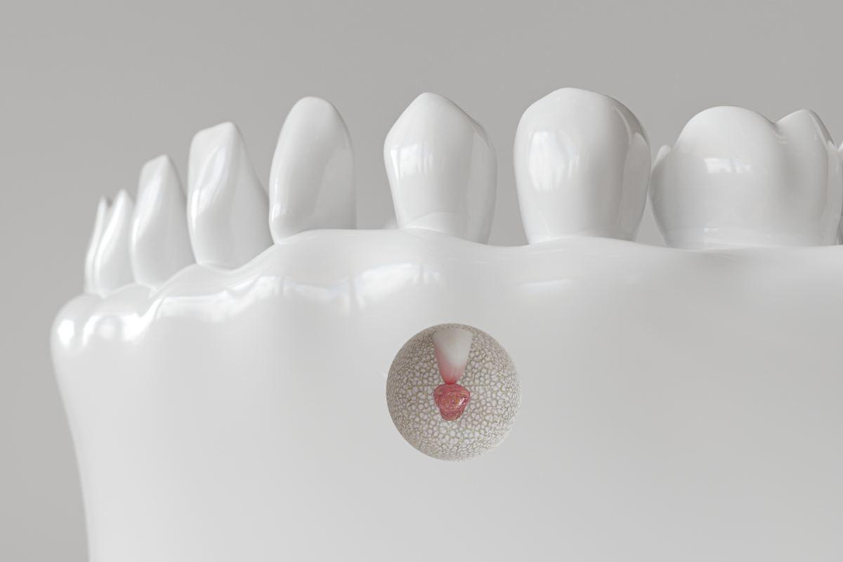 Chirurgie endodontique