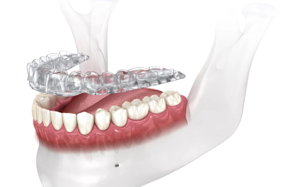 Occlusodontie
