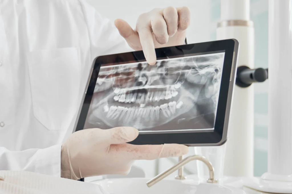 Retraitement endodontique