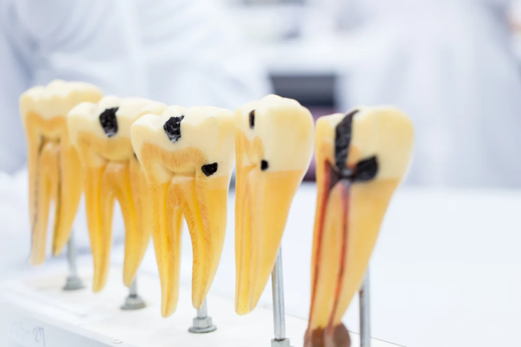 Traitement endodontique initial
