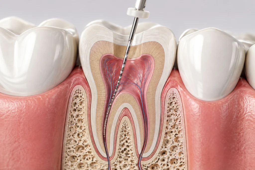 Traitement endodontique initial